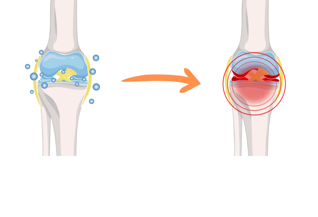 Synovil tingkatkan gel lutut dan bantu kurangkan keradangan sendi